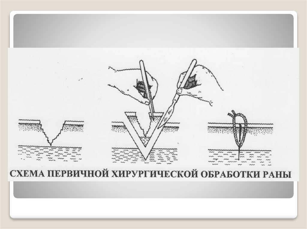 Пхо ран. Схему первичной хирургической обработки РАН. Этапы первичной обработки раны. Туалет раны и первичная хирургическая обработка Пхо раны.