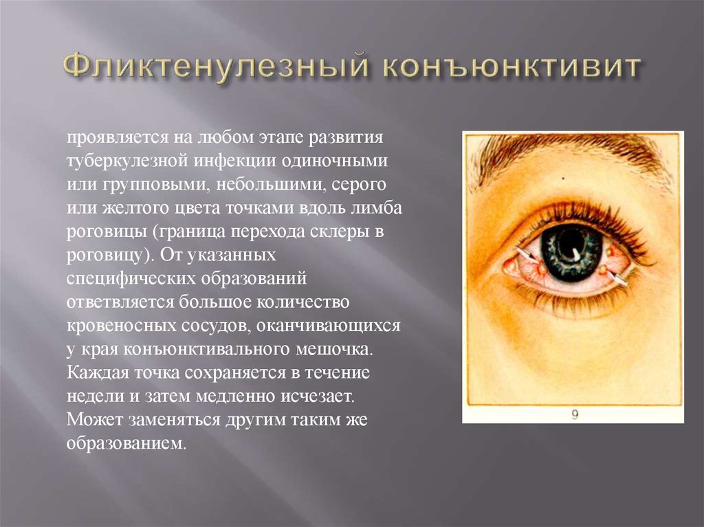 Глазной конъюнктивит лечение
