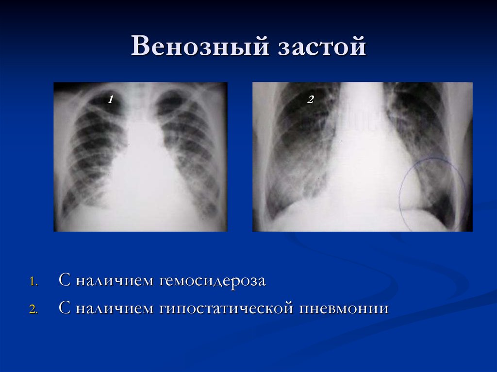 Венозный застой. Венозный застой в легких рентген. Застой в легких рентген. Застойные явления в легких рентген. Венозный застой рентген признаки.