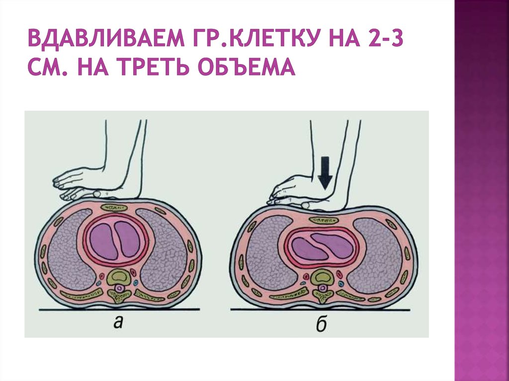 Вдавливаем гр.клетку на 2-3 см. на треть объема