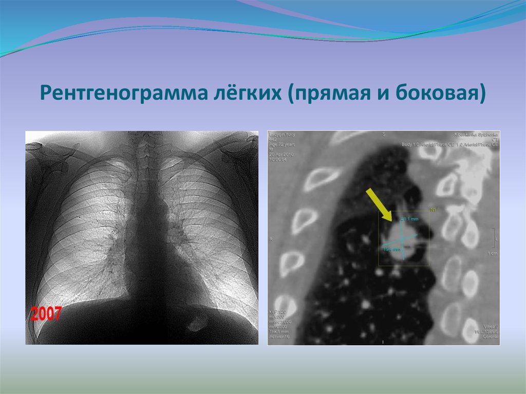 Рентгенограмма лёгких (прямая и боковая)