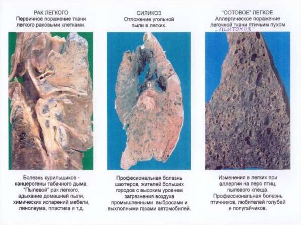 Профессиональные болезни легких. Болезнь легких силикоз. Силикоз профессиональное заболевание.