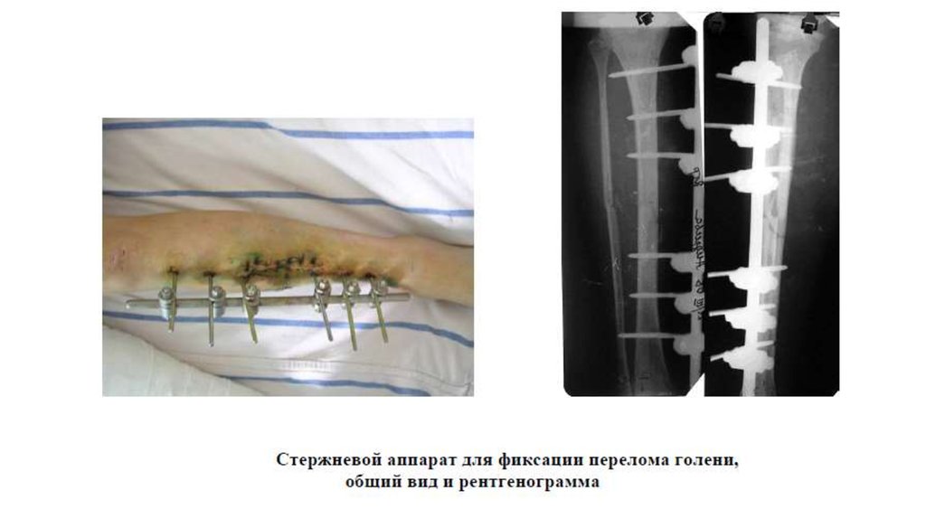 Внеочаговый остеосинтез презентация