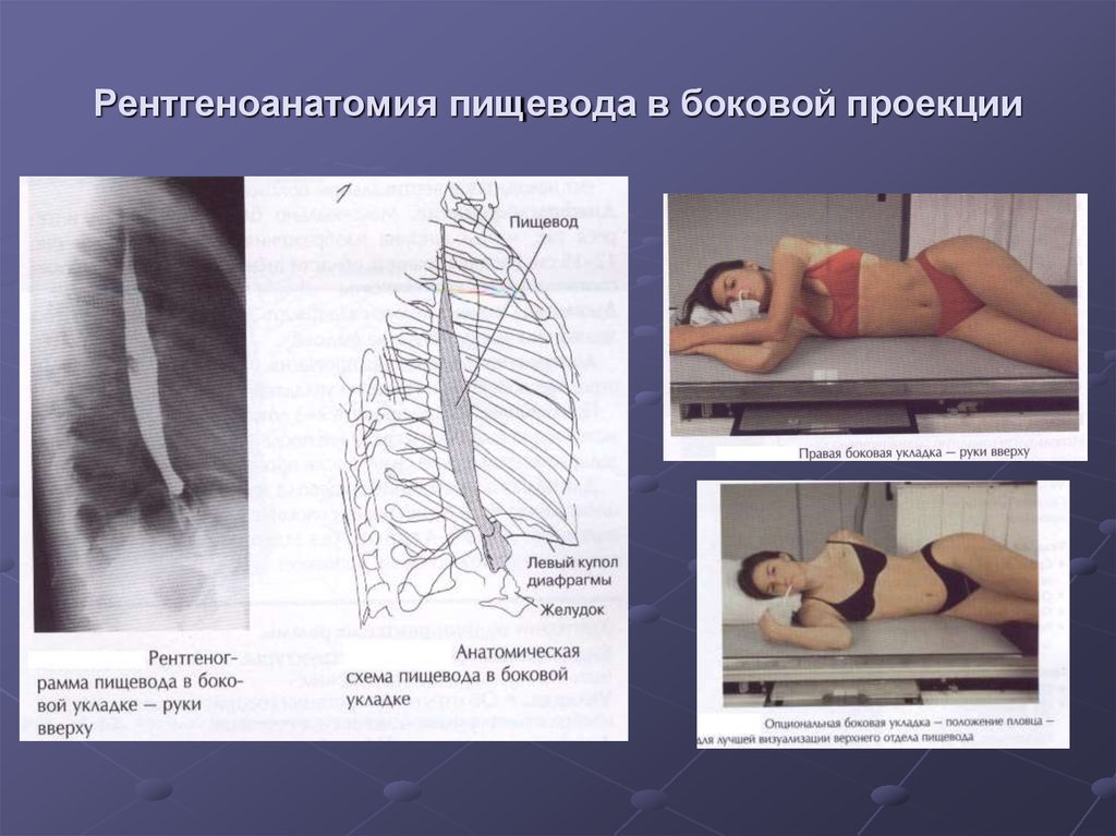 Боковая проекция. Рентген пищевода в положении Тренделенбурга. Ренгтен анатомия пищевода. Рентгенатоммря пищевода. Рентгенанатоитя пищеводп.