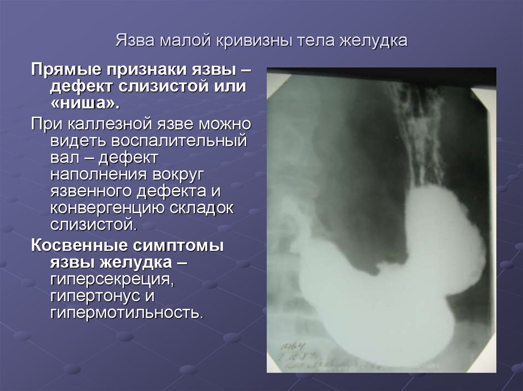Как проявляется язва симптомы. Пенетрирующая язва желудка рентген. Рентген язвы желудка симптом ниши. Пенетрирующая язва малой кривизны желудка рентген. Язва желудка рентген ниша.