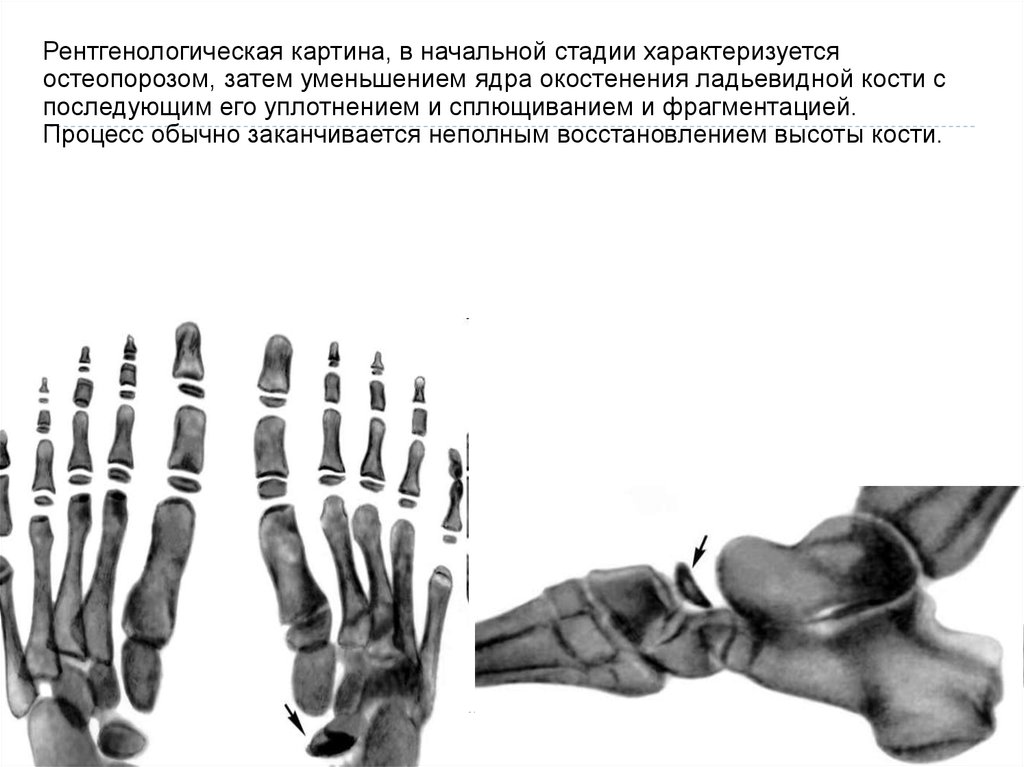 Остеохондропатии у детей презентация