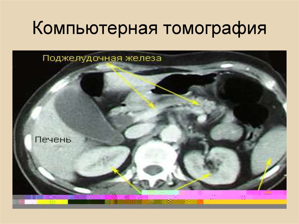 Кт поджелудочной железы. Кальцификация поджелудочной железы кт. Проток поджелудочной железы кт. Компьютерная томография поджелудочной железы. Воспаление головки поджелудочной железы кт.