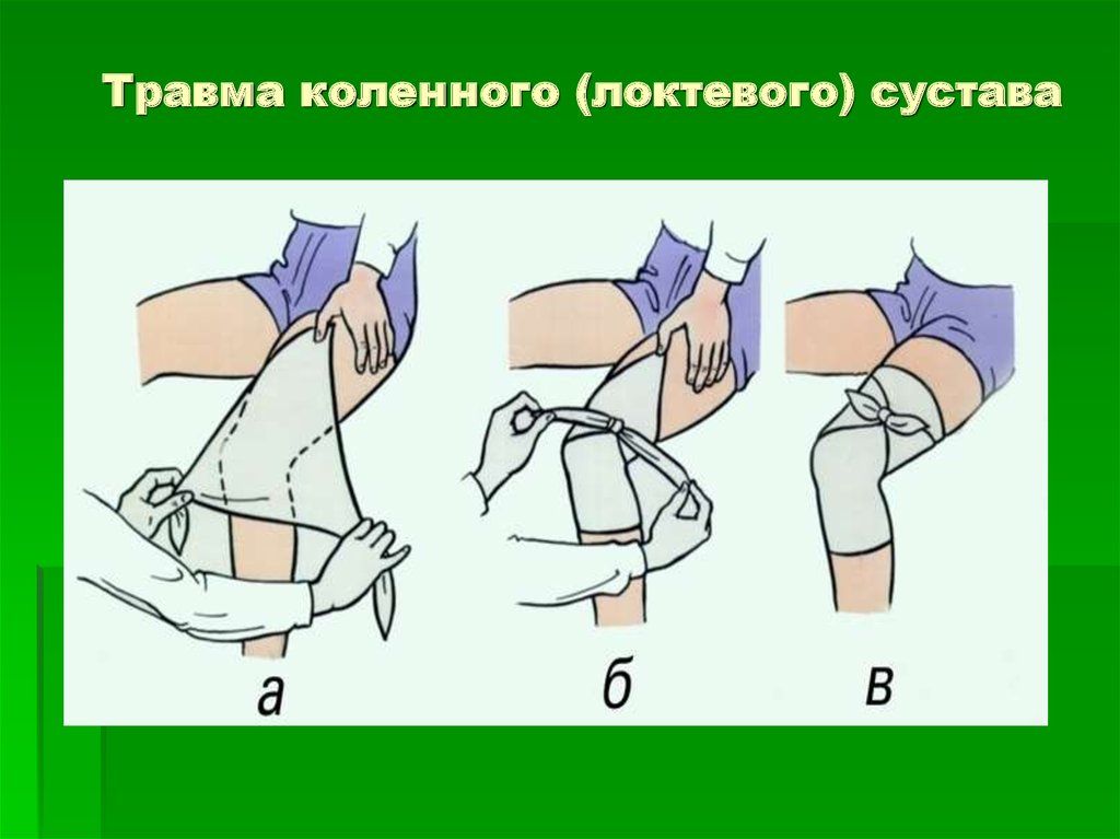 Перевязка локтя. Косыночная повязка на локтевой и коленный сустав. Косыночная повязка алгоритм наложения. Косыночная повязка на коленный сустав. Повязка при вывихе коленного сустава.