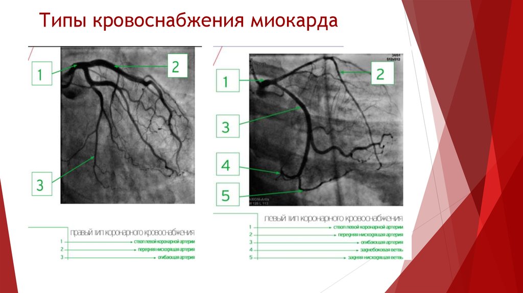 Типы кровообращения. Типы кровоснабжения миокарда. Левый Тип кровоснабжения миокарда. Типы кровоснабжения миокарда на коронарографии. Правый Тип кровоснабжения миокарда.