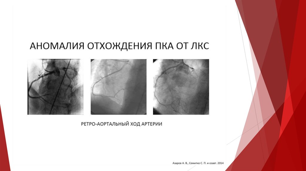 Гипоплазия правой коронарной артерии сердца. Эхондрома правого КС.