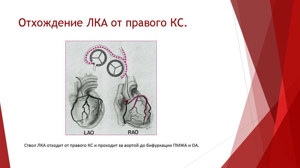 Левая коронарная артерия. Аномалии отхождения аорты. Аномалии отхождения коронарных артерий от аорты. Отхождение лка от легочной артерии. Аномальное отхождение левой коронарной артерии на ЭХОКГ.