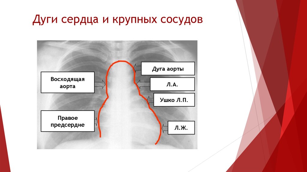 Расширение левой. Контуры сердца рентген. Рентген анатомия сердца дуги. Дуги сердца на рентгене. Дуги контура сердца на рентгенограмме.