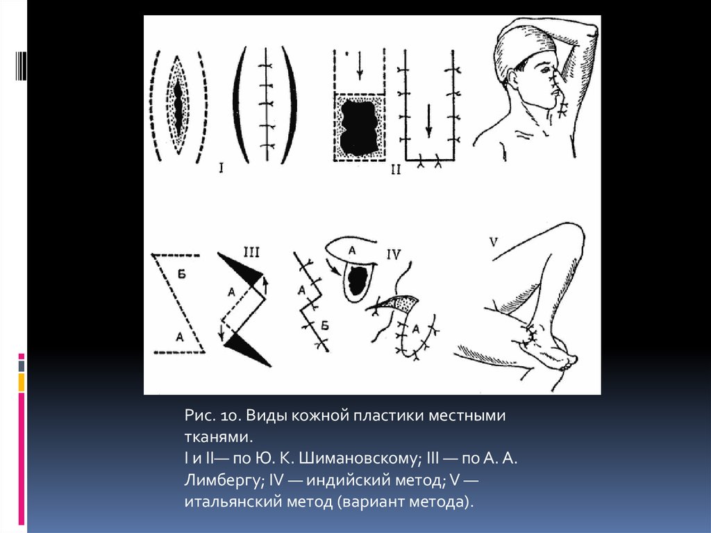 Пластика кожи. Кожная пластика итальянский метод. Пластика по ю.к. Шимановскому. Метод Лимберга кожная пластика. Лимберг пластика местными тканями.