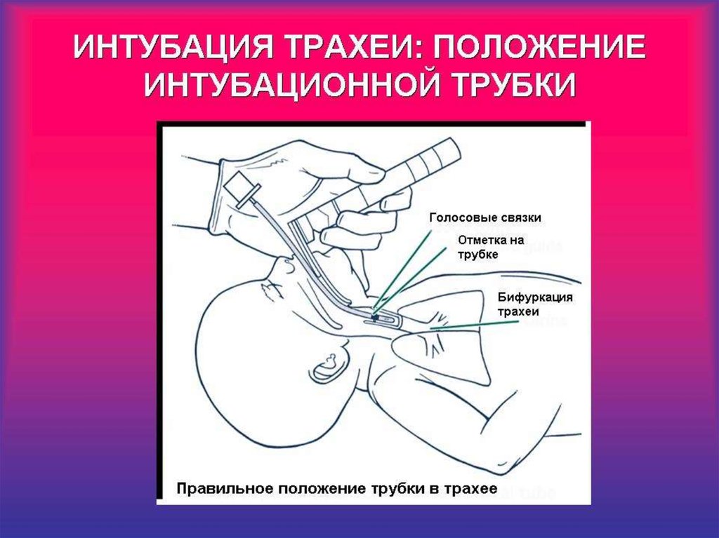 Интубация трахеи презентация