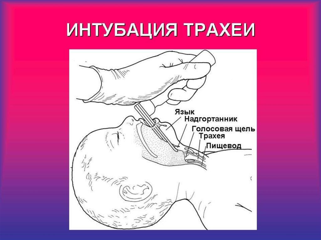 Интубация трахеи презентация