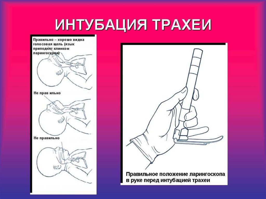 Интубация трахеи. Реанимация интубация трахеи. Методика интубации трахеи детей. Интубация трахеи у новорожденных.