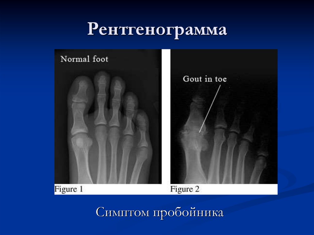 Подагра рентген. Подагрический артрит рентген стадии. Подагра рентген симптом пробойника. Подагрический артрит рентген признаки. Симптомы подагры рентген.