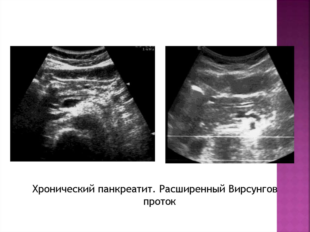 Расширен проток поджелудочной. Хронический панкреатит УЗИ. Вирсунгов проток поджелудочной УЗИ. Ультрасонография поджелудочной железы. УЗИ картина нормальной поджелудочной железы..