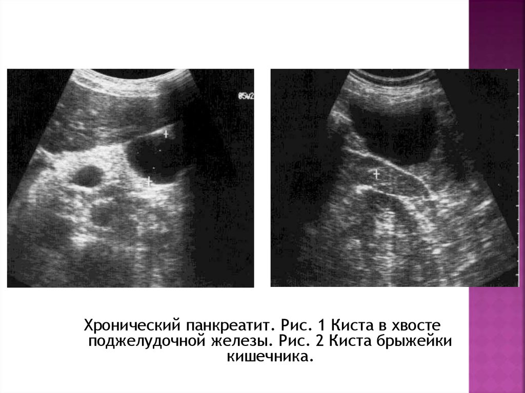 Псевдокиста поджелудочной железы. Киста поджелудочной железы на УЗИ. Киста головки поджелудочной железы 11мм. Кистозное образование хвоста поджелудочной железы.