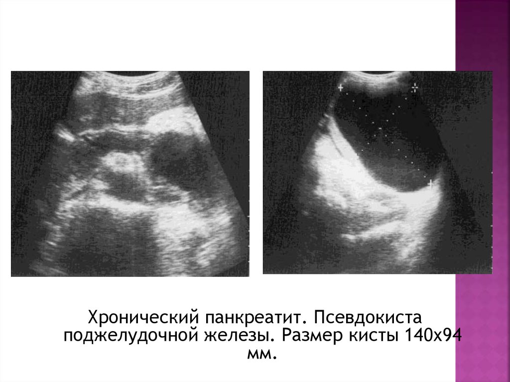 Псевдокиста поджелудочной железы. Псевдокисты поджелудочной железы на УЗИ. Кальцинированная псевдокиста поджелудочной железы. Киста псевдокиста поджелудочная железа УЗИ. Хронический панкреатит УЗИ.