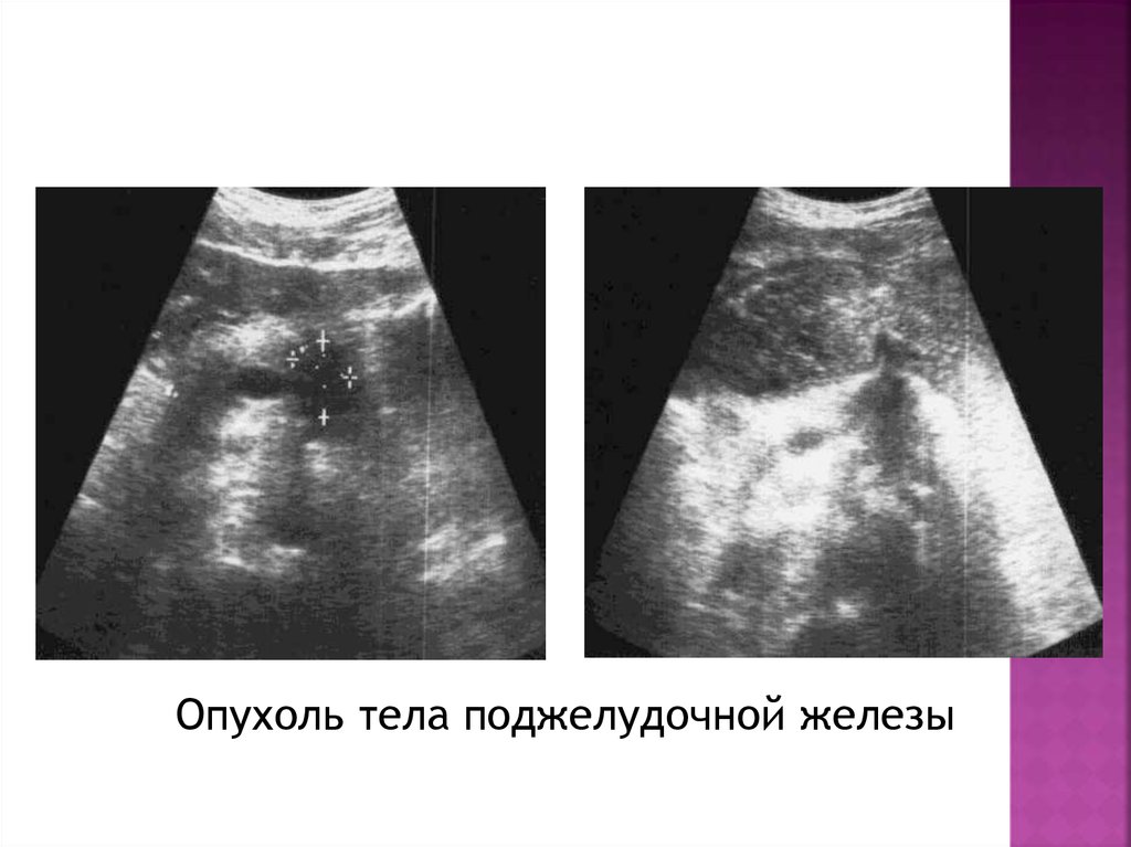 Узи поджелудочной отзывы. Ультразвуковое исследование поджелудочной железы. УЗИ поджелудочной железы. Опухоль поджелудочной железы на УЗИ. УЗИ поджелудочной железы презентация.