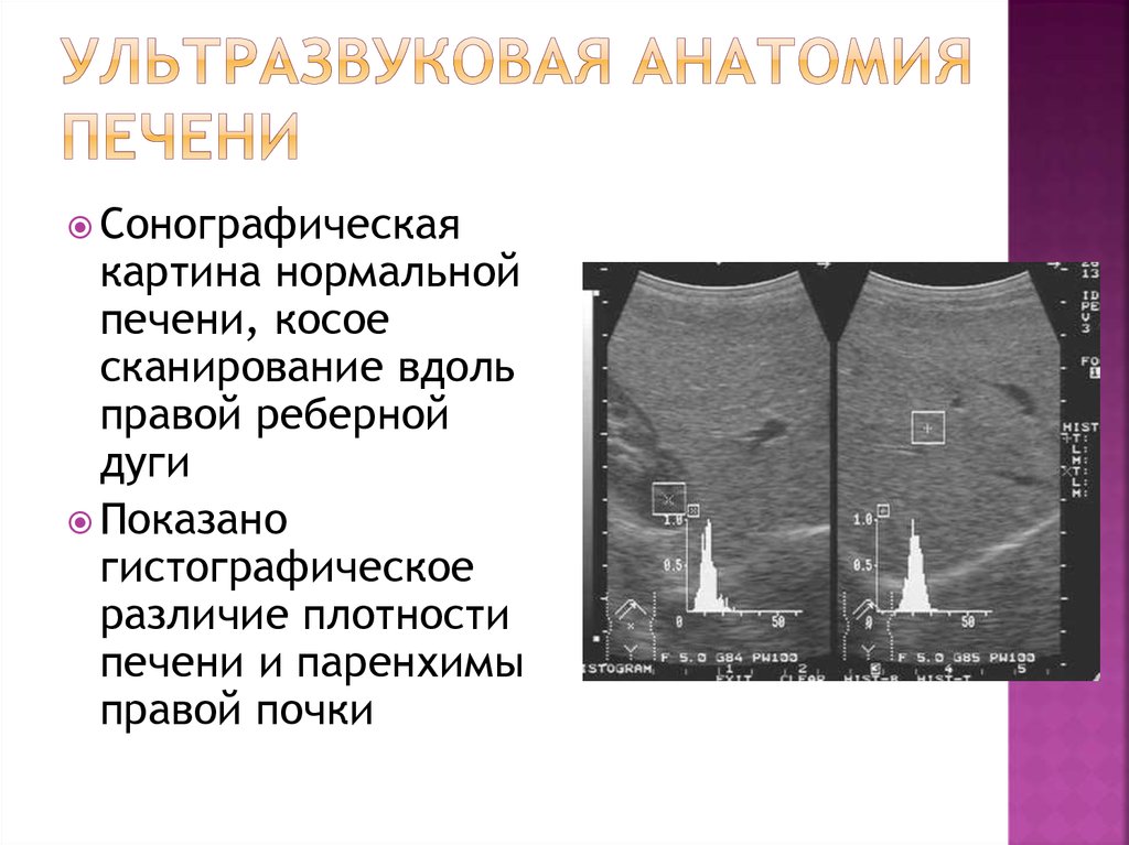 Кт норма печень. Ультразвуковая анатомия. Плотность печени. Снижение плотности печени. Ультразвуковая анатомия печени.