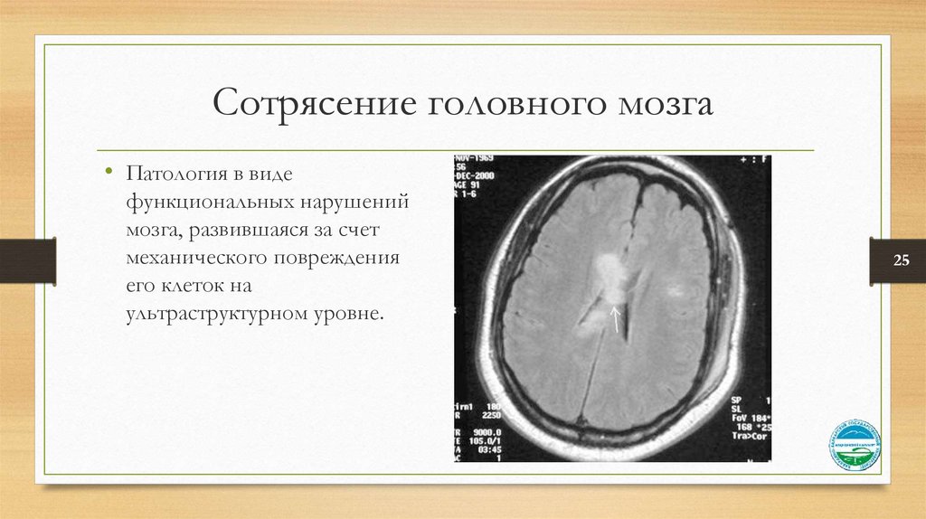 Виды сотрясений. Сотрясение головного м. Сотрясени еголовоного мозга. Закрытые травмы головного мозга грудной клетки. Сотрясение мозга рентген.
