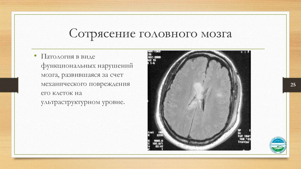 Сотрясение головного тяжести