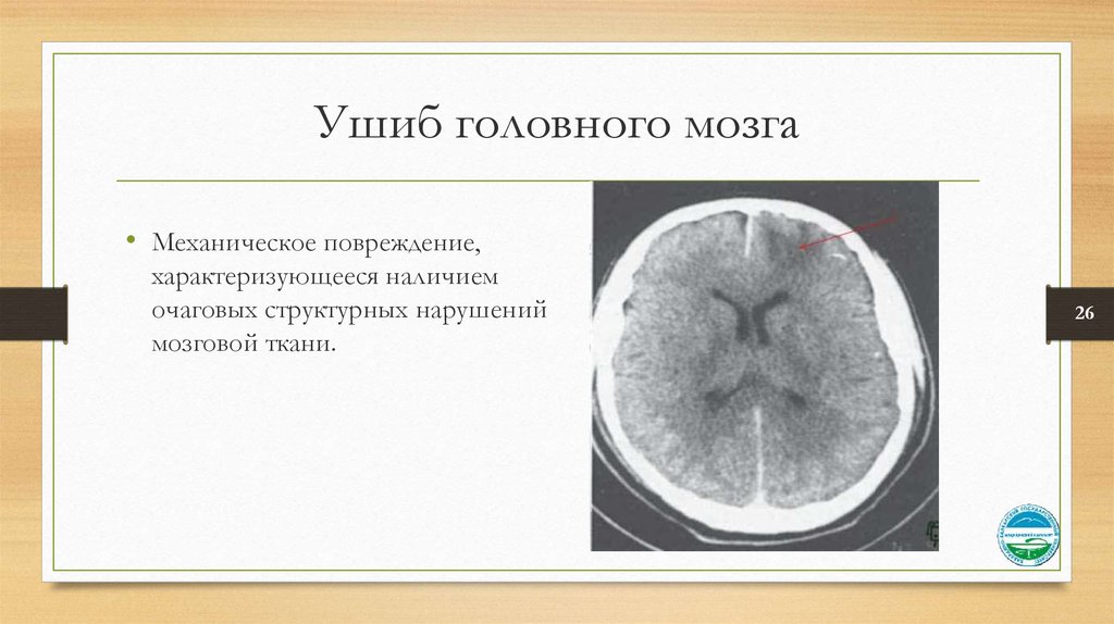 Какие признаки ушиба головного мозга