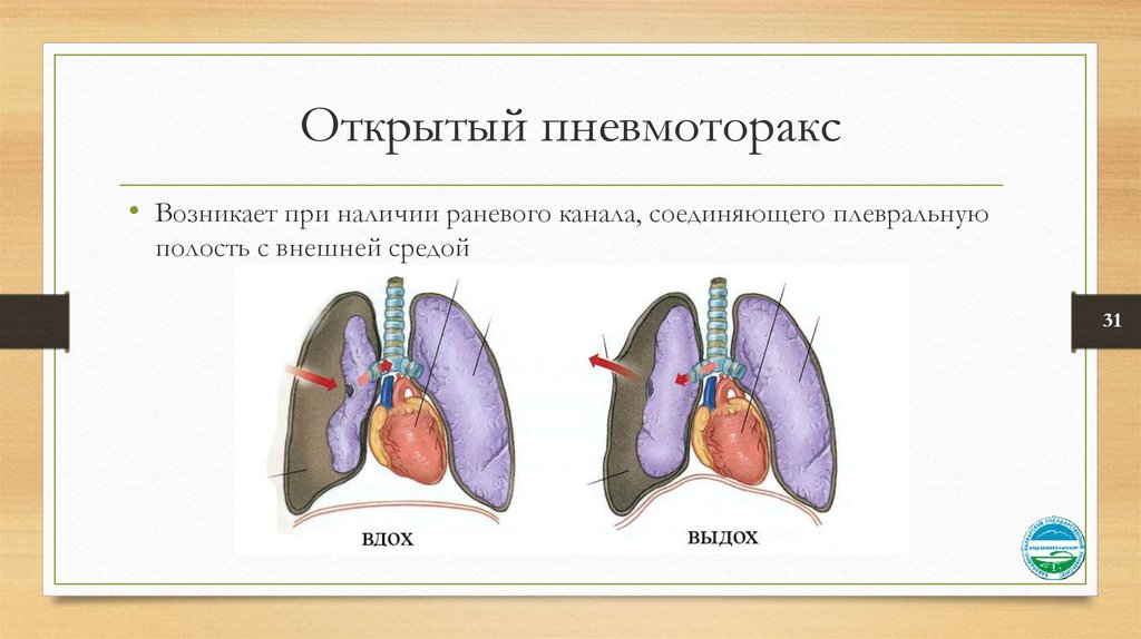 Наличие закрытый. Механизм развития открытого пневмоторакса. Пневмоторакс открытый закрытый клапанный. Симптомы открытого пневмоторакса. Признаки открытого пневмоторакса.