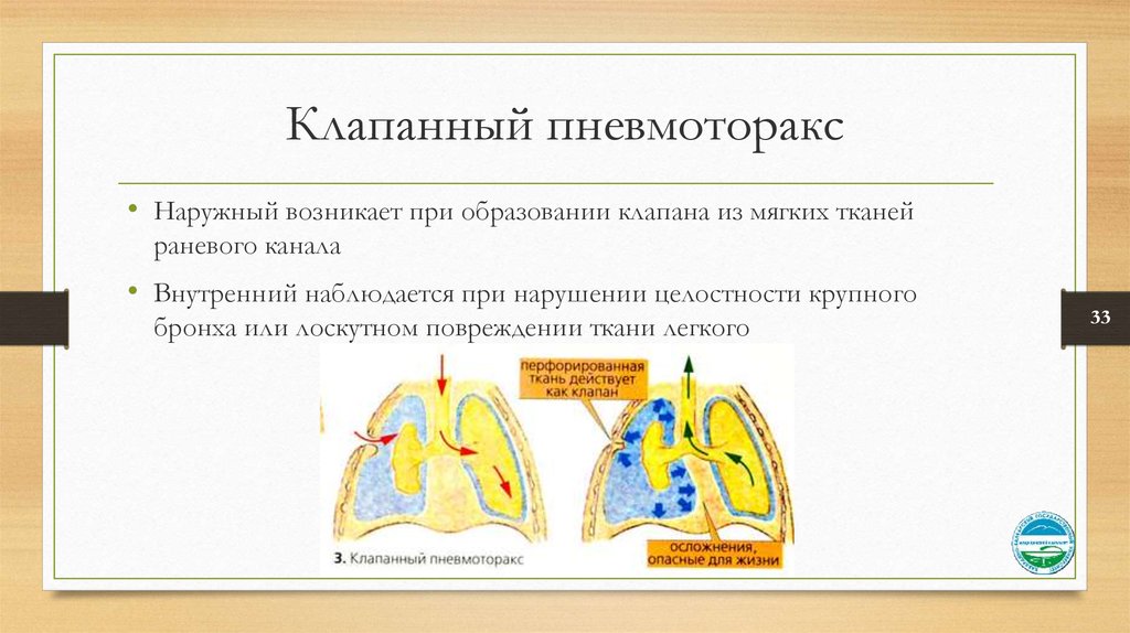 Закрытый внутренний. Наружный и внутренний клапанный пневмоторакс. Клапанный пневмоторакс характеризуется. Наружный клапанный пневмоторакс. Наружный пневмоторакс механизм образования.