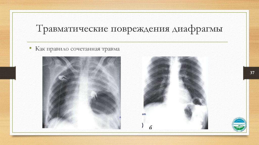 Симптом диафрагмы. Посттравматические повреждения диафрагмы. Травматическое повреждение диафрагмы рентген. Ранение диафрагмы рентген. Травматический разрыв диафрагмы симптомы.