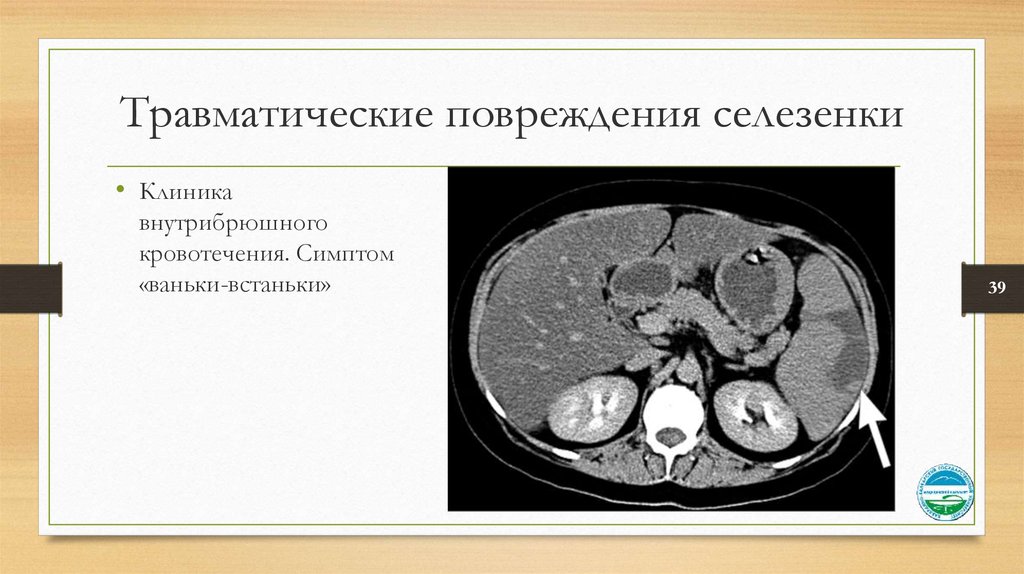 Травмы селезенки презентация