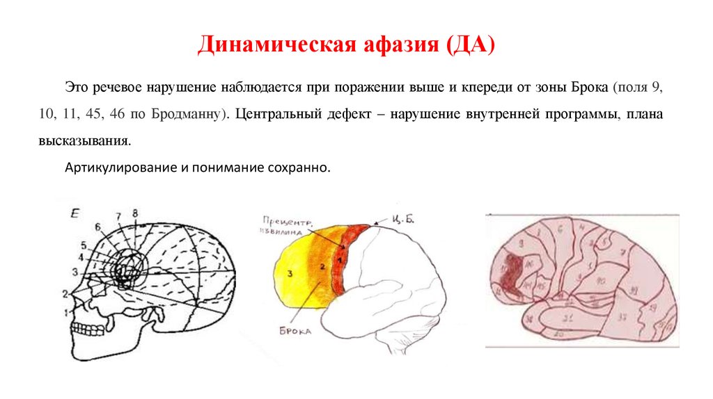 При афазии нарушаются. Очаг поражения при динамической афазии. Эфферентная моторная афазия зона поражения. Очаг поражения при моторной афазии. Динамическая афазия зона поражения.