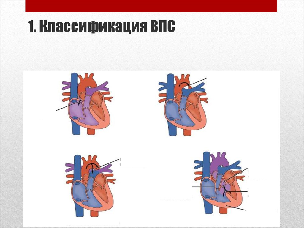 Пороки сердца у детей