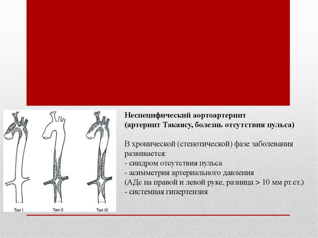 Артериит такаясу презентация