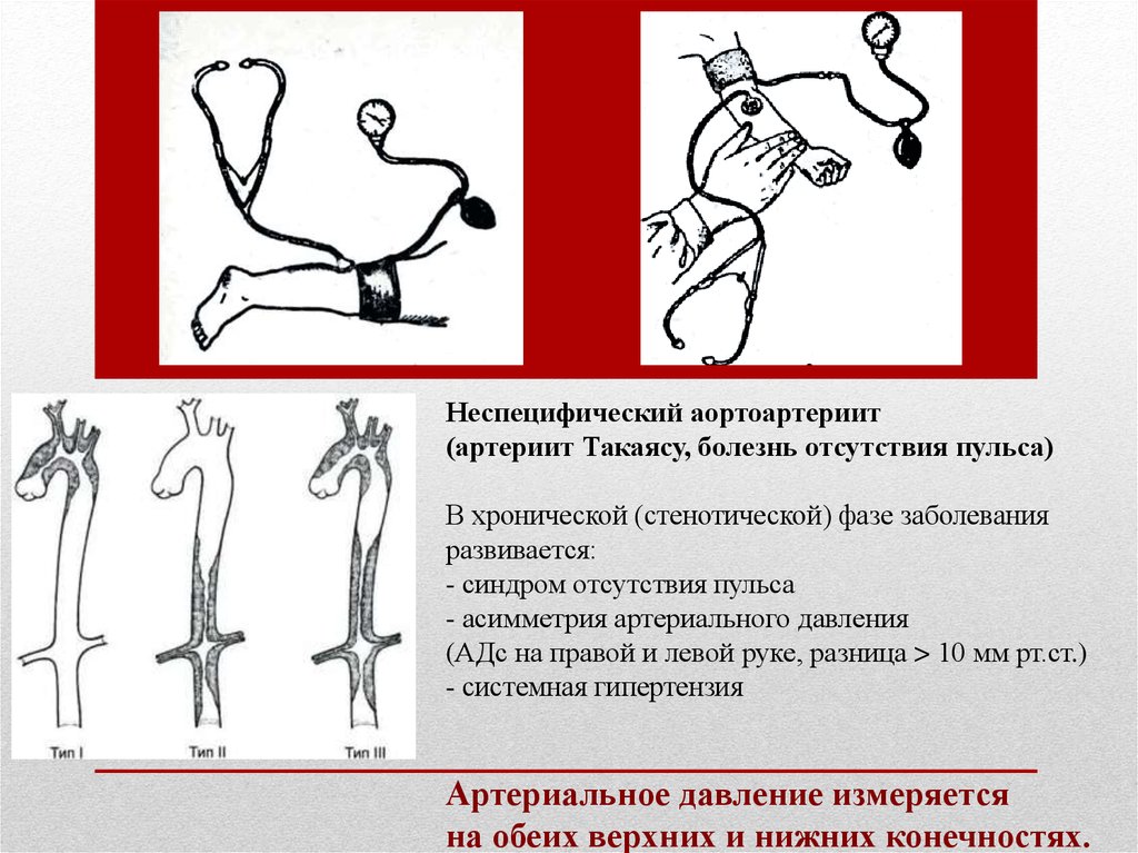 Артериит такаясу презентация