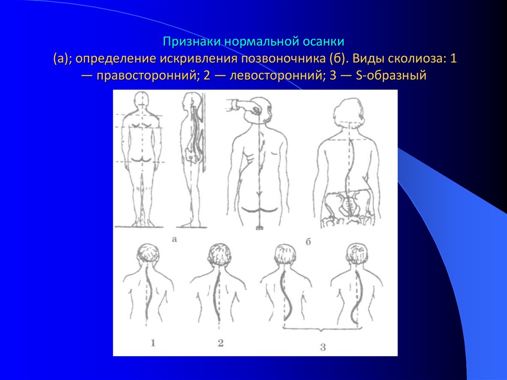 Признаки нормального человека. Признаки нормальной осанки. Признаки нормальной осанки и искривления позвоночника. 5 Признаков нормальной осанки. 3)Признаки нормальной осанки..