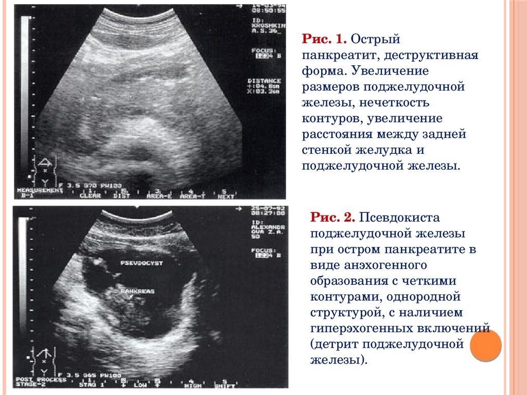 Размеры поджелудочной железы. Острый деструктивный панкреатит УЗИ. Острый панкреатит псевдокиста. Псевдокиста поджелудочной железы на УЗИ. УЗИ при остром панкреатите.