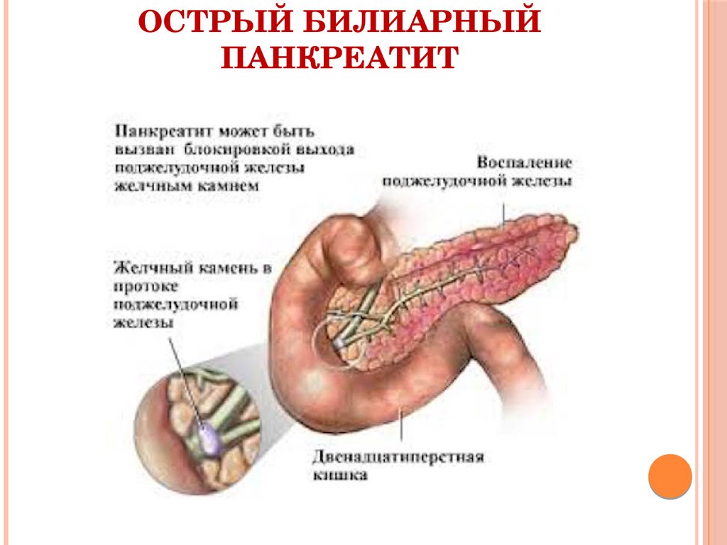 Воспаление поджелудочной железы желчного пузыря. Билиарный панкреатит синдромы. Хронический билиарный панкреатит. Билиарнозависимый панкреатит панкреатит. Острый билиарный панкреатит причины.