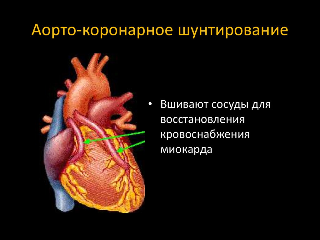 Что такое шунтирование сердца и сосудов. Шунтирование коронарных артерий. Аорто-коронарное шунтирование. Маммарокоронарное шунтирование. Коронарное шунтирование схема.