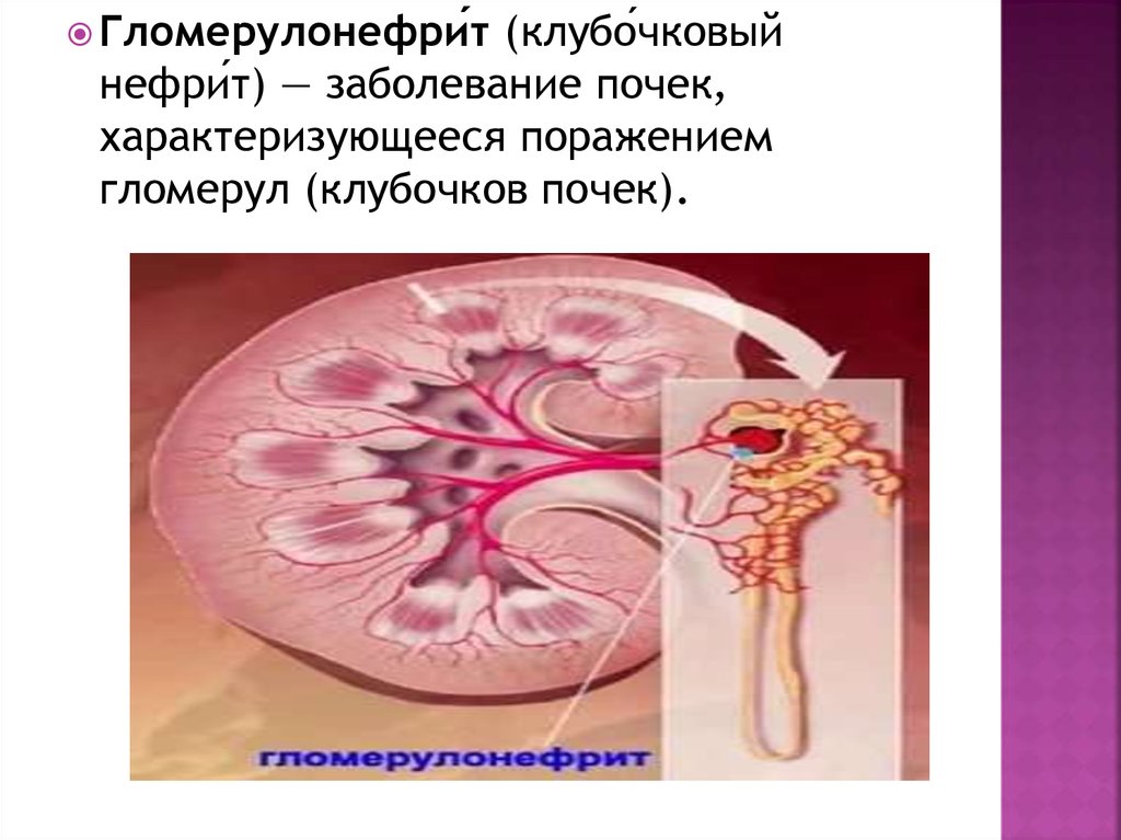 Гломерулонефрит нефрит почек