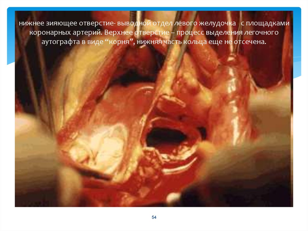 нижнее зияющее отверстие- выводной отдел левого желудочка с площадками коронарных артерий. Верхнее отверстие – процесс