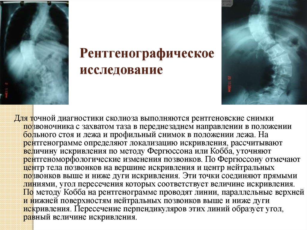 Описание рентген снимка. Сколиоз заключение рентген. Рентгеновское заключение сколиоз 2 степени. Сколиоз 4 степени рентген описание. Сколиоз 1 степени рентген описание.