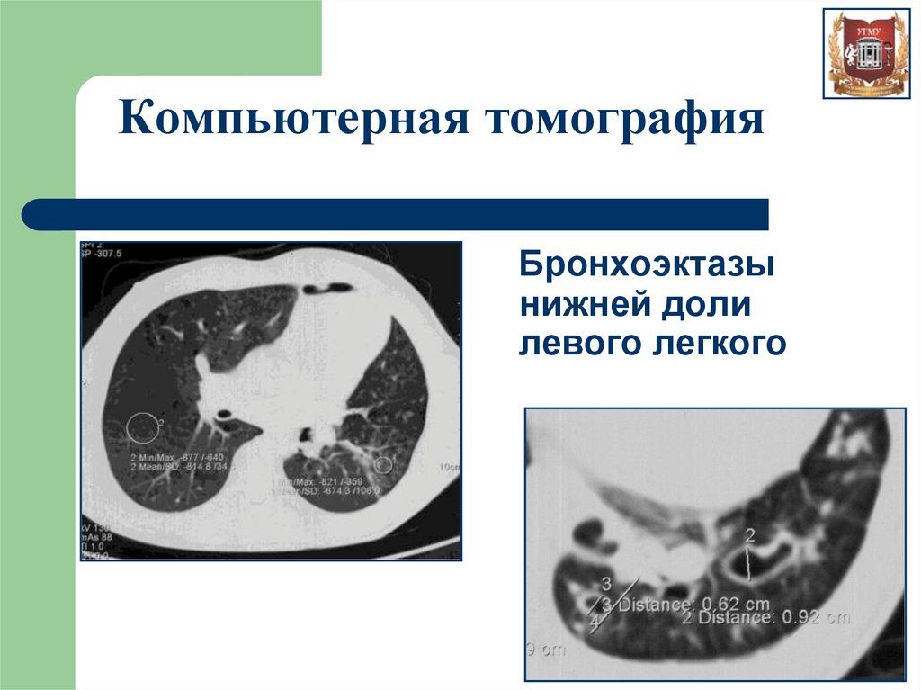 Кт картина бронхоэктазов