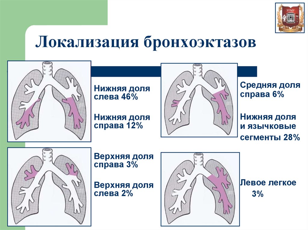 Бронхоэктатическая болезнь факультетская терапия презентация