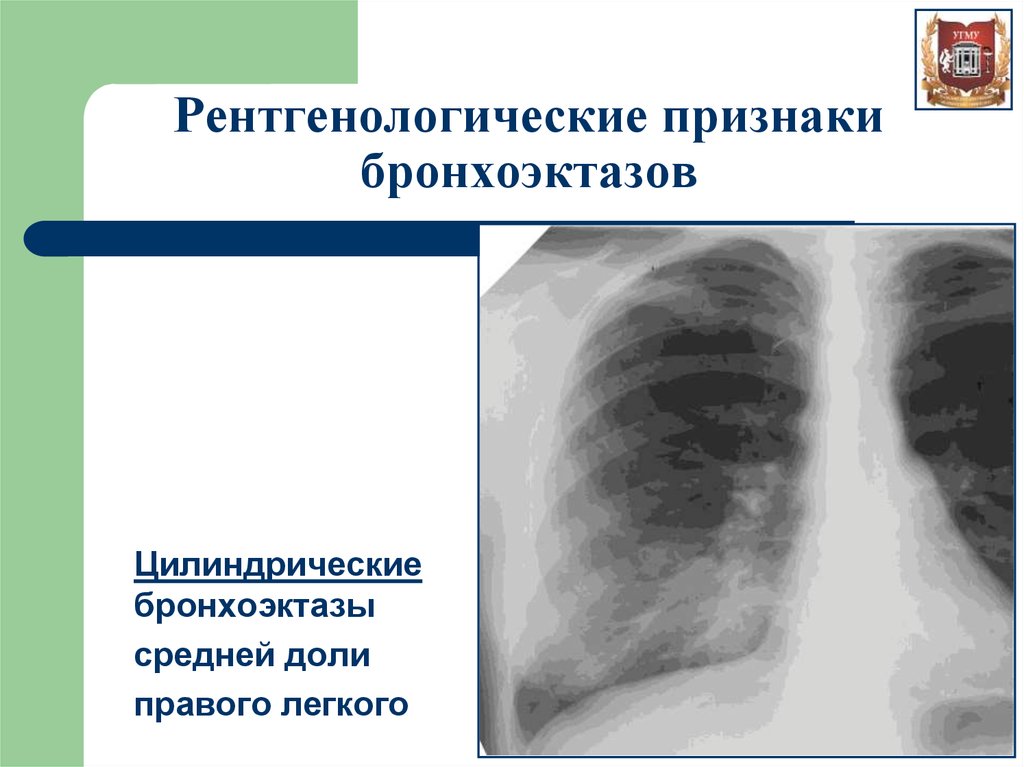 Бронхоэктазы нижней доли