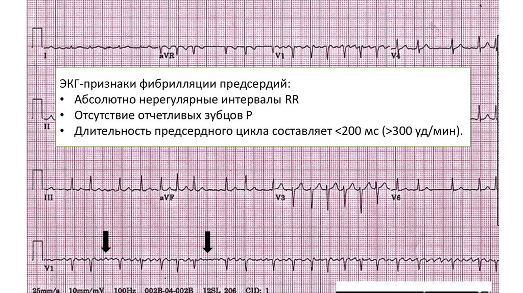 Трепетание предсердий карта вызова смп