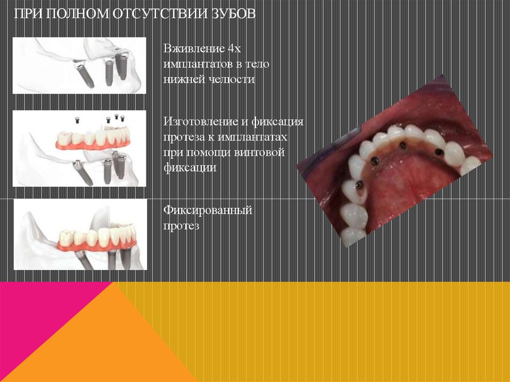 Методы фиксации и стабилизации съемных протезов при полном отсутствии зубов презентация