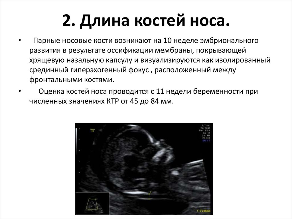 Норма воротникового пространства в 13 недель. УЗИ норма ТВП 12 недель беременности. УЗИ носовой кости плода на 12 неделе. УЗИ 13 недель беременности носовая кость. Норма ТВП В 12 недель беременности по УЗИ.